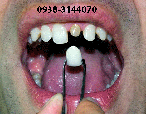 قیمت روکش دندان |روکش دندان | 22594512-021