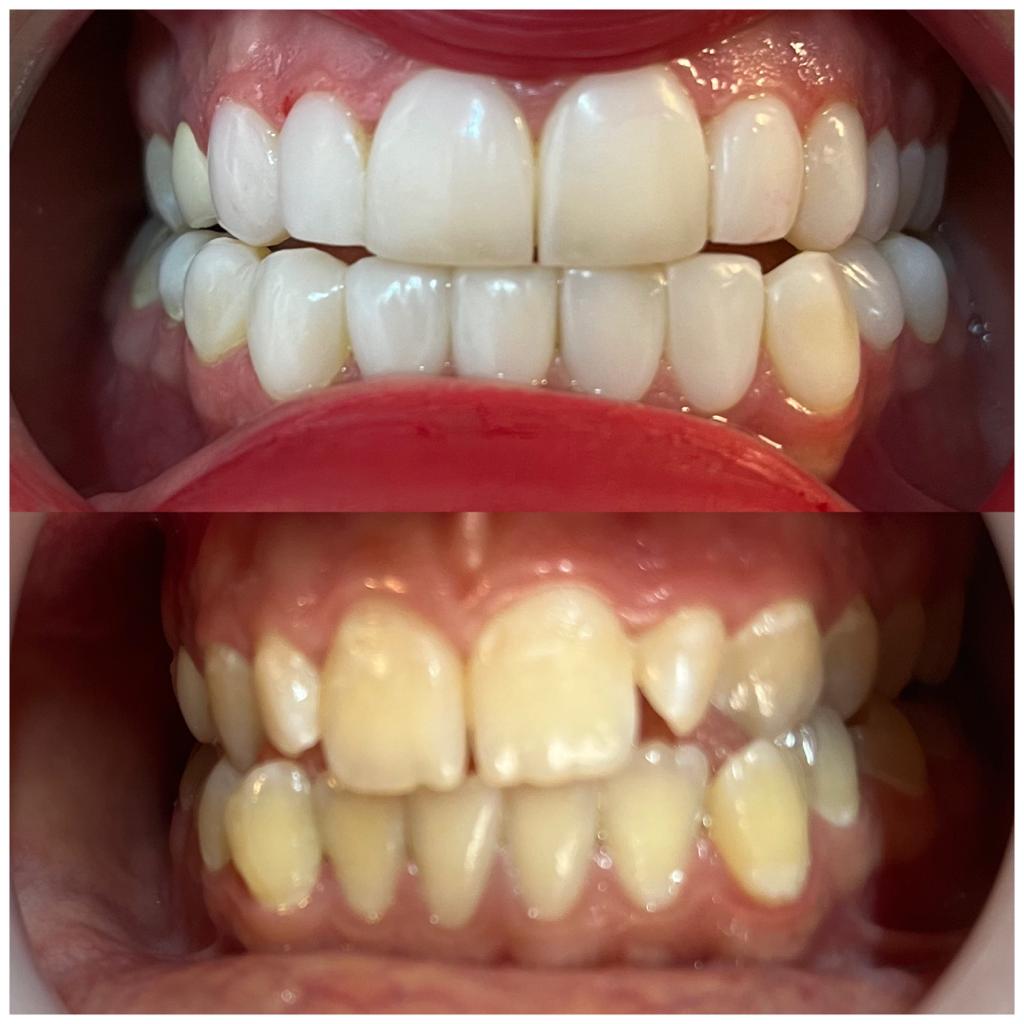 کامپوزیت دندان | 22594512-021